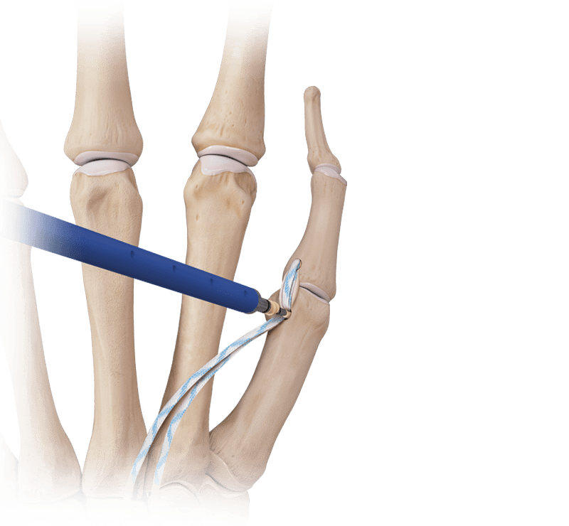 Arthrex - Hand/Wrist InternalBrace™ Ligament Augmentation Repair
